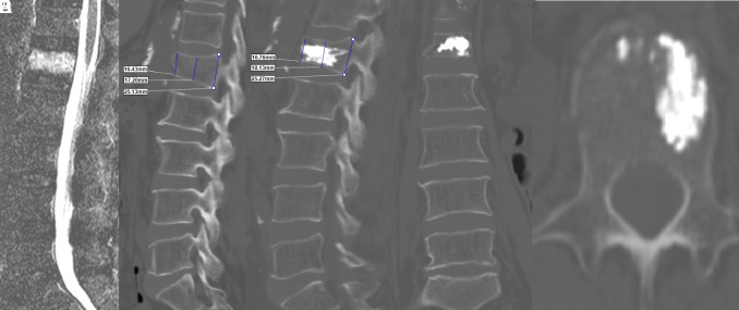 Efficacy of bone cement volume in unilateral kyphoplasty of thoracolumbar compression fractures: A clinical comparative study.