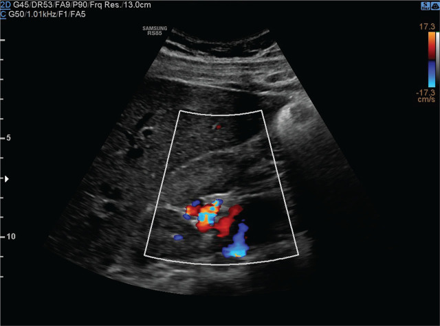 IVCA in a Boy with Multilocular Renal Cyst as a Risk Factor for Deep Vein Thrombosis.