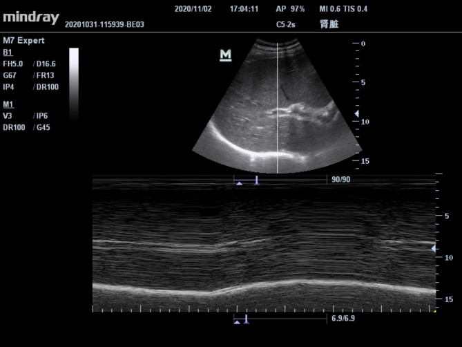 Coracoid approach brachial plexus block combined with posterior suprascapular nerve block provides analgesia for shoulder arthroscopy: a randomized controlled trial.