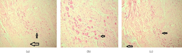 Synchronous Ipsilateral Adrenal and Retroperitoneal Ganglioneuroma: A Unique Case of Large Tumor Mass.