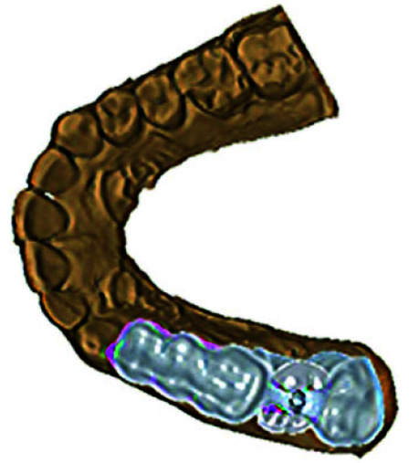 A Novel Technique to Retrieve Cement Retained Implant Supported Prosthesis with Digital Imaging: A Technical Report.