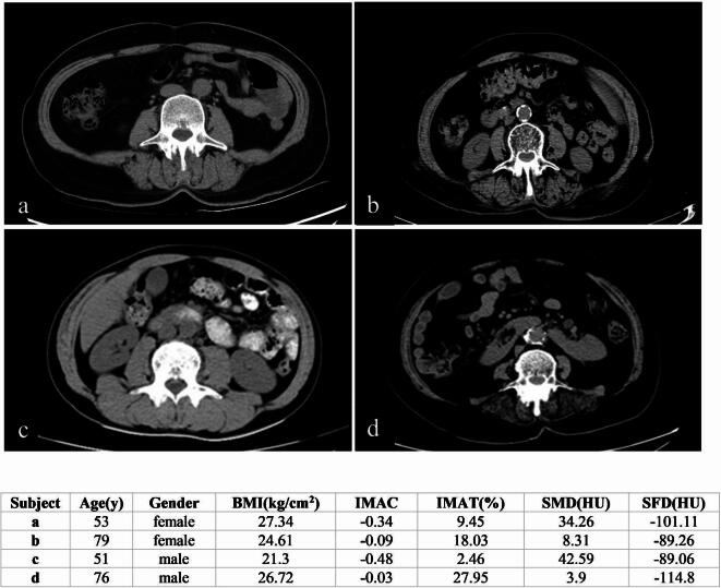Intermuscular adipose tissue affected muscle density more than intramuscular adipose tissue content with opportunistic screening at abdominal CT.