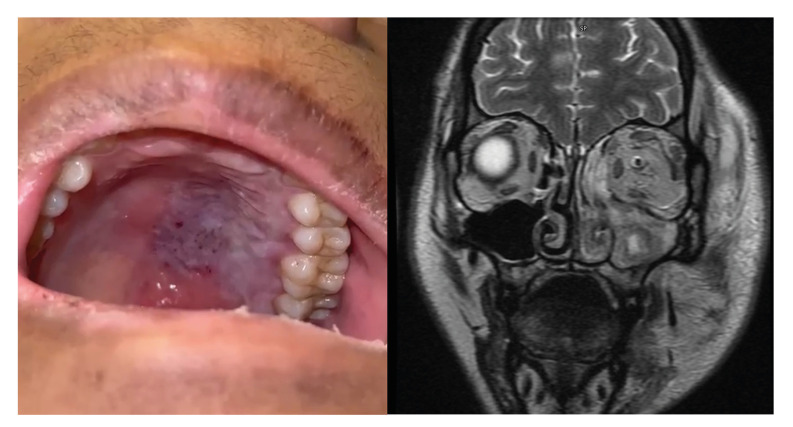 Impact of risk factors in craniofacial mucormycosis.