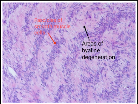 Broad Ligament Leiomyomata - An Important Differential Diagnosis in Huge Abdominal Mass: A Case Report.