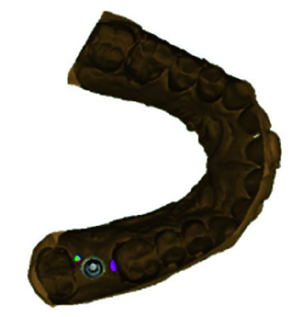A Novel Technique to Retrieve Cement Retained Implant Supported Prosthesis with Digital Imaging: A Technical Report.