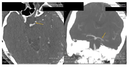 Acute artery of Percheron stroke: To treat or retreat with thrombolysis?