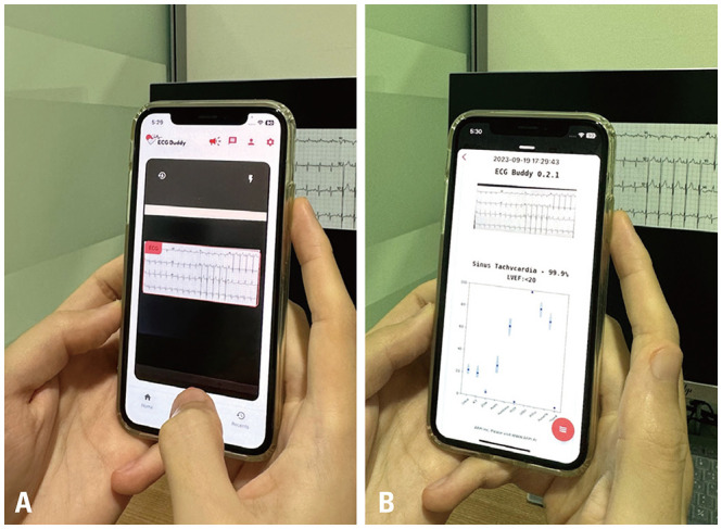 Non-Inferiority Analysis of Electrocardiography Analysis Application vs. Point-of-Care Ultrasound for Screening Left Ventricular Dysfunction.