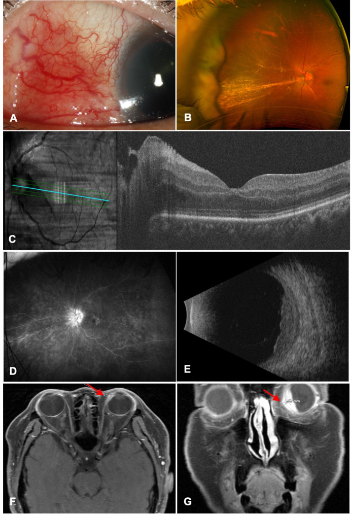 Presumed granulomatosis with polyangiitis presenting with anterior scleritis and inflammatory ciliary body granuloma.