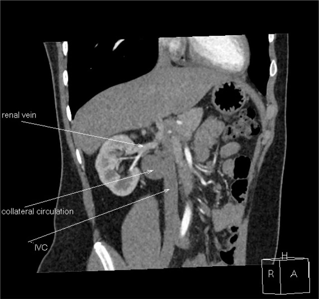 IVCA in a Boy with Multilocular Renal Cyst as a Risk Factor for Deep Vein Thrombosis.