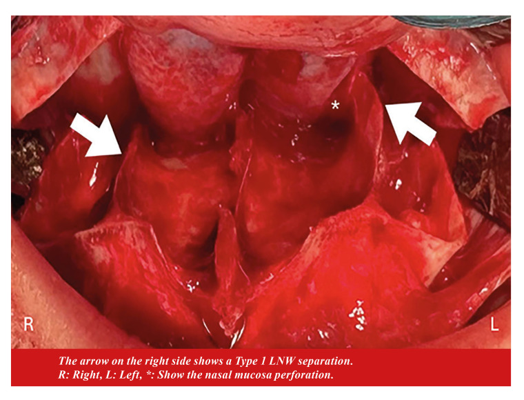 What is the impact of lateral nasal wall osteotomy depth on pterygomaxillary separation during a Le Fort I downfracture?