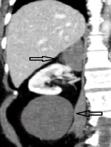 Synchronous Ipsilateral Adrenal and Retroperitoneal Ganglioneuroma: A Unique Case of Large Tumor Mass.