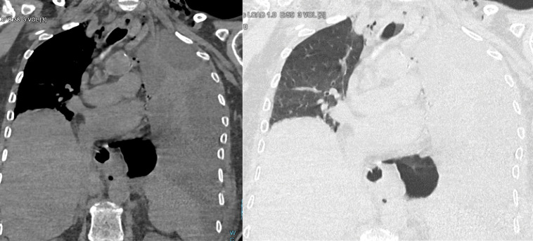 Boerhaave Syndrome: A Case Report.