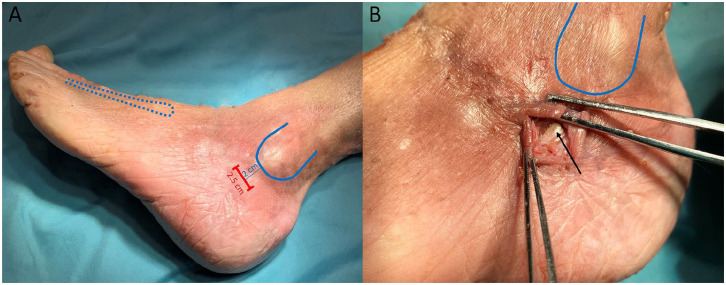 Minimally Invasive Cartilage Resection of the Subtalar Joint: An Anatomical Study.