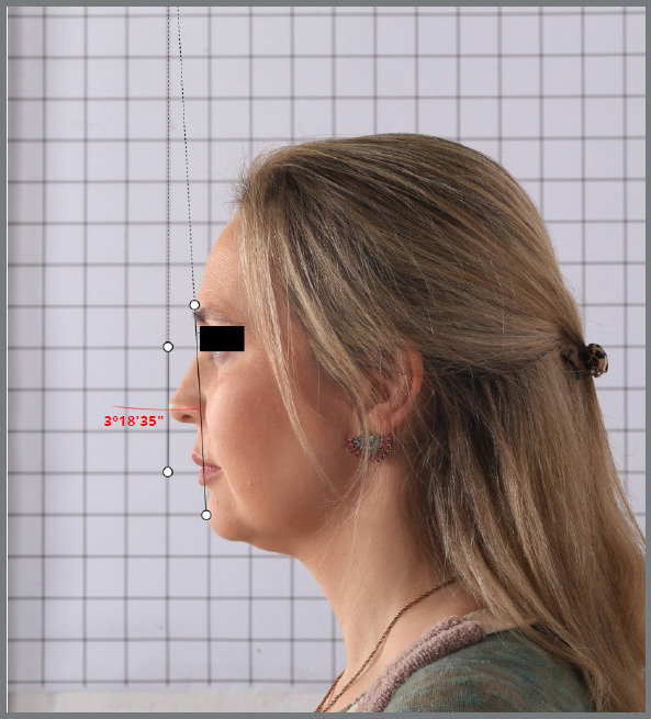 Evaluation of the reproducibility of facial profile photographic records taken in two different head positions.