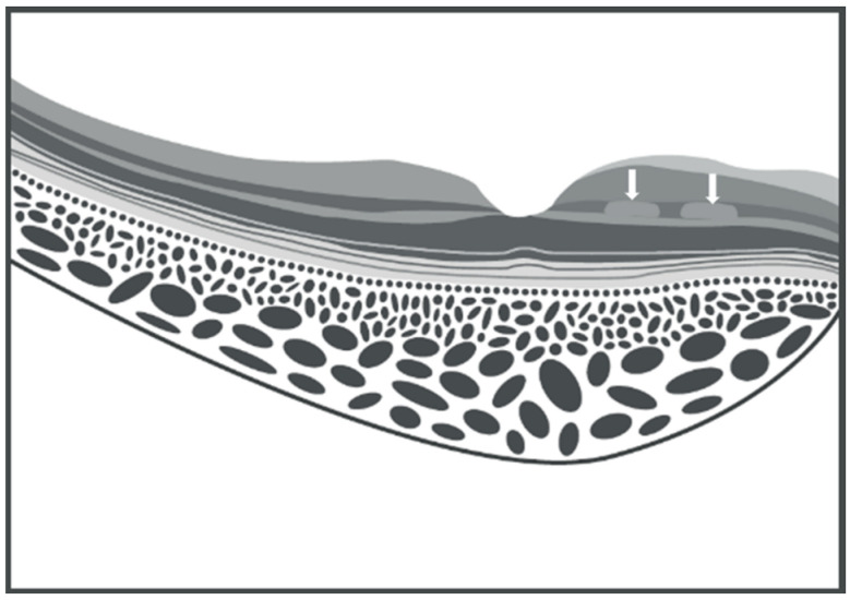 Paracentral Acute Middle Maculopathy (PAMM) in Ocular Vascular Diseases-What We Know and Future Perspectives.