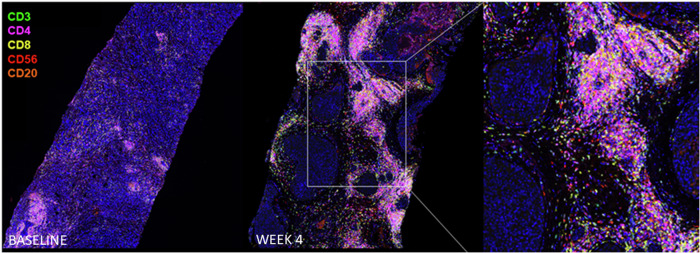 A pilot study incorporating HER2-directed dendritic cells into neoadjuvant therapy of early stage HER2+ER- breast cancer.