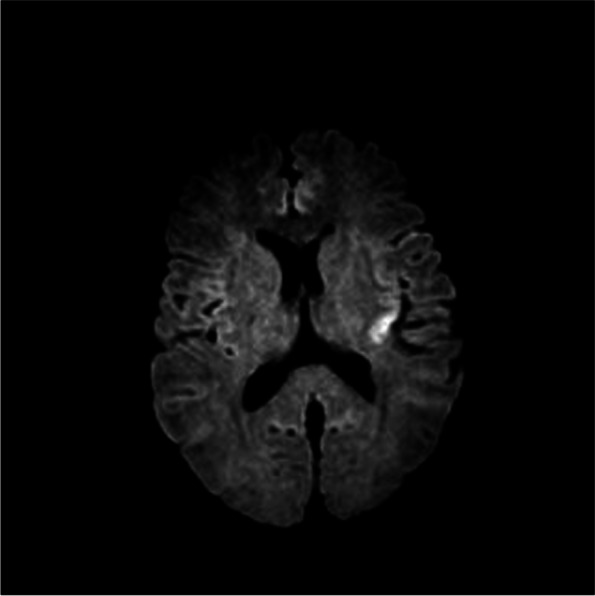 A case of dimethyl sulfoxide-induced seizure in multiple myeloma.
