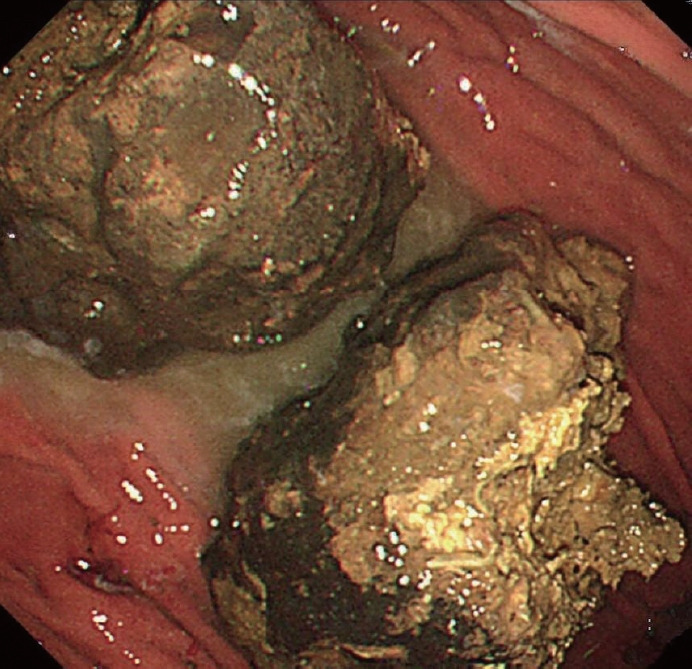 Treatment of a Large Gastric Phytobezoar With Coca-Cola, Cellulase, and Endoscopic Fragmentation in a Community Hospital.