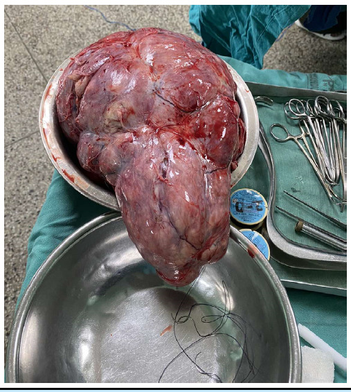 Broad Ligament Leiomyomata - An Important Differential Diagnosis in Huge Abdominal Mass: A Case Report.