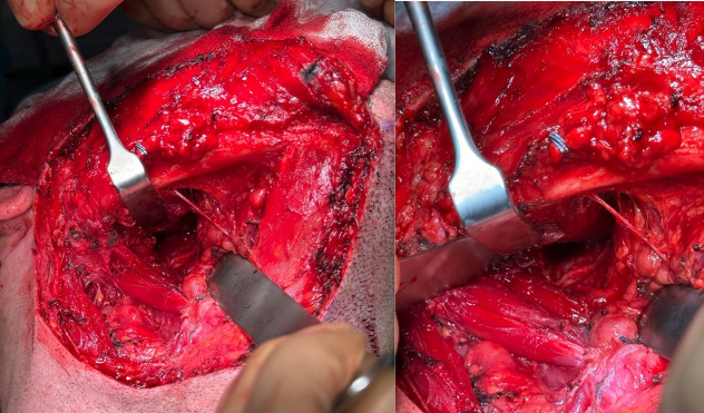 Computer-Aided excision of Parapharyngeal Space Pleomorphic Adenoma by Transcervical Approach. Case report.