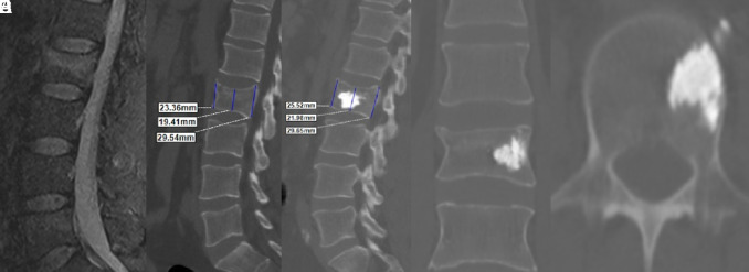 Efficacy of bone cement volume in unilateral kyphoplasty of thoracolumbar compression fractures: A clinical comparative study.