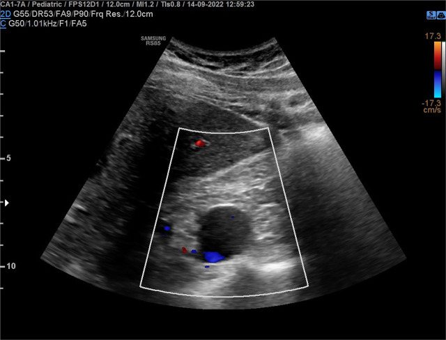 IVCA in a Boy with Multilocular Renal Cyst as a Risk Factor for Deep Vein Thrombosis.