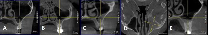 Anatomical and Pathological Assessment of the Maxillary Sinus Using CBCT Imaging: A Retrospective Descriptive Study.