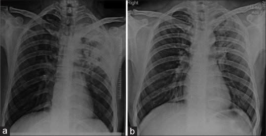 Radiological resolution of community-acquired pneumonia in hospitalised patients in North India.