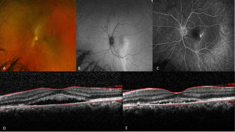 Comparative efficacy of half-dose and one-third-dose photodynamic therapy in chronic central serous chorioretinopathy: a retrospective study.