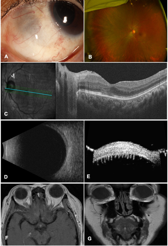 Presumed granulomatosis with polyangiitis presenting with anterior scleritis and inflammatory ciliary body granuloma.
