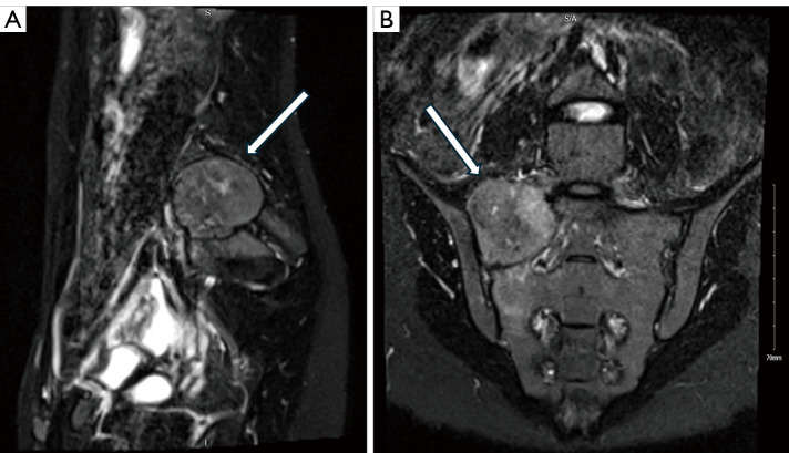 A 3D navigation-guided surgical resection of a rare case of sacral spine mesenchymal chondrosarcoma: a case report.