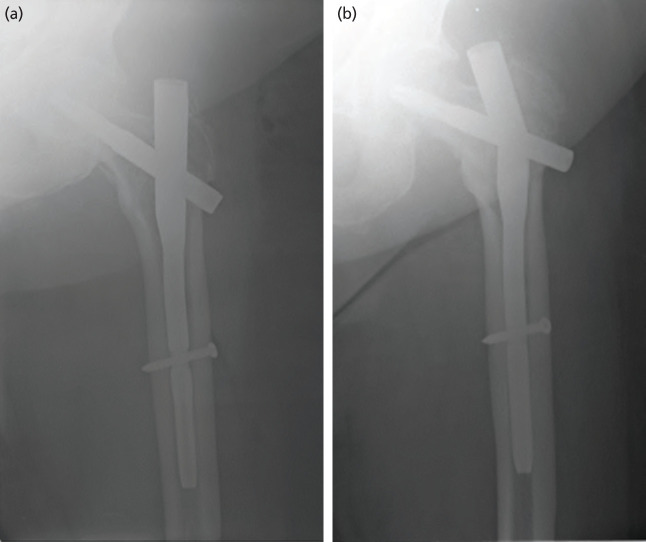 A Prospective, Randomised Controlled Trial Comparing the use of the Proximal Femoral Nail - Antirotation and Dynamic Hip Screw for Stable Intertrochanteric Femur Fractures-Stable Trochanteric Fractures Intramedullary versus Extramedullary (STRIVE) Study.