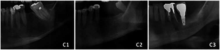 The influence of age, sex, and mandibular morphometric parameters on cortical bone width and erosion: a panoramic radiography study.