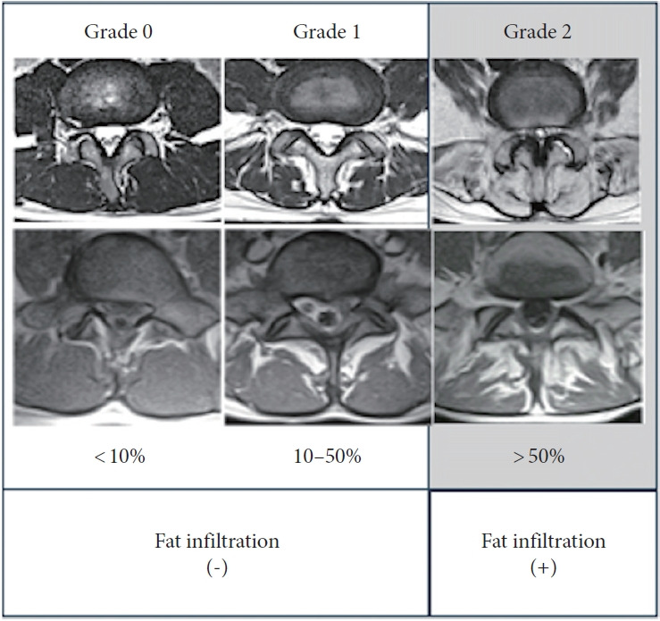 Impact of Paraspinal Muscle Degeneration on Surgical Outcomes and Radiographical Sagittal Alignment in Adult Spinal Deformity: A Multicenter Study.