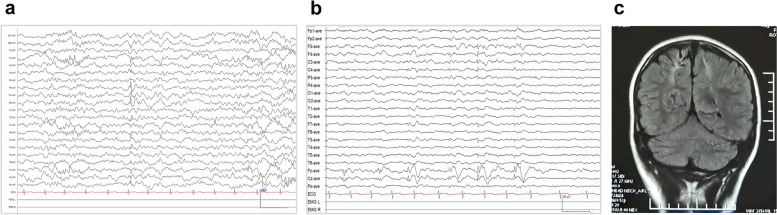 MDN1 variants cause susceptibility to epilepsy : For the China Epilepsy Gene 1.0 Project.