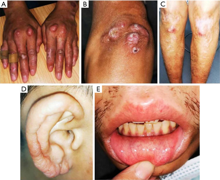 Two missense mutations in Dystonin lead to epidermolysis bullosa simplex complicated with lepromatous leprosy: a case report.