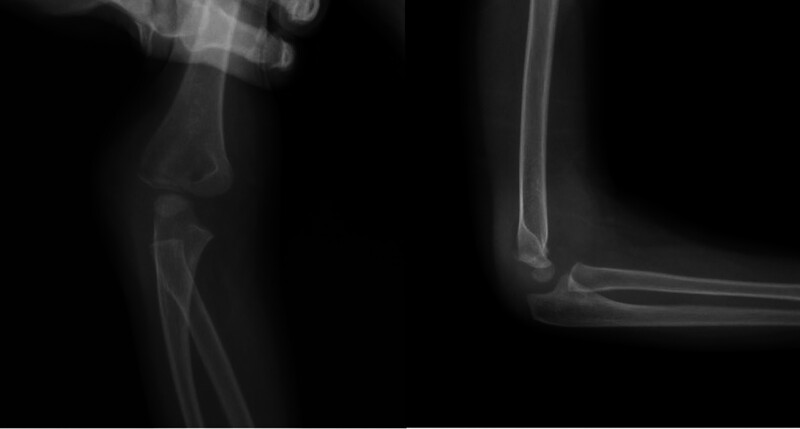 Comparison of radiological, clinical, and functional results of Jakob type 2 lateral condyle fractures treated with closed reduction and percutaneous pinning versus open reduction and K-wire fixation.
