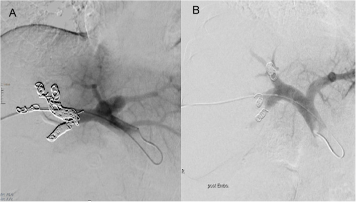 Future liver remnant hypertrophy and postoperative outcomes: a retrospective comparison between segmental and main right portal vein embolization.