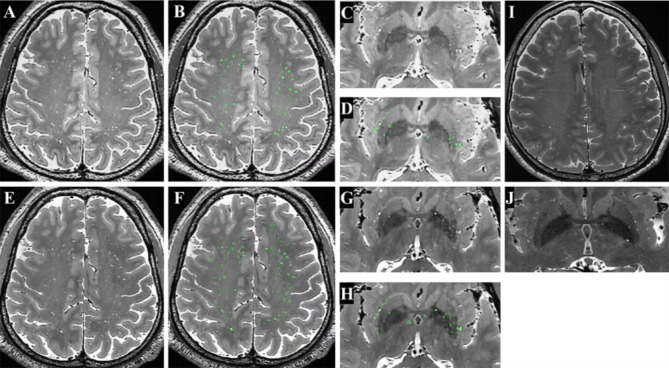Visualization of perivascular spaces in the human brain with 5-T magnetic resonance imaging.