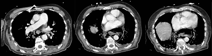 Boerhaave Syndrome: A Case Report.