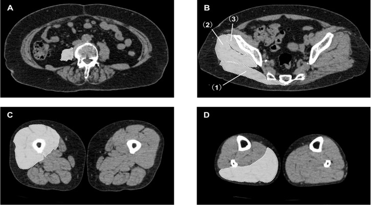 Fatty Infiltration of Muscles Influences Short-term Walking Speed after Primary Total Hip Arthroplasty.