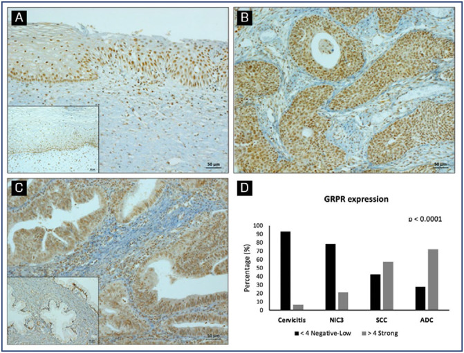 Gastrin-releasing peptide receptor: a promising new biomarker to identify cervical precursor lesions and cancer.
