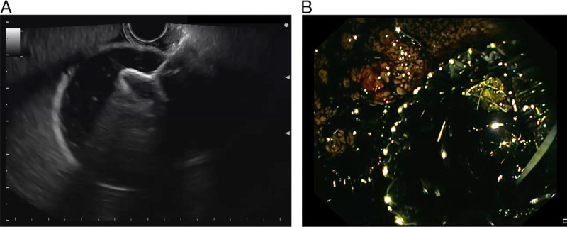 Outcomes of a multicenter registry on EUS-guided gallbladder drainage as a rescue technique for malignant distal biliary obstruction after failed endoscopic retrograde cholangiopancreatography.