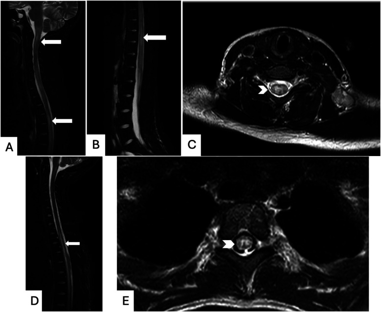 Diagnosis, treatment, and functional outcomes for two adolescent female patients with lupus myelitis: a case report.