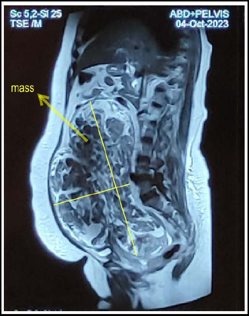 Broad Ligament Leiomyomata - An Important Differential Diagnosis in Huge Abdominal Mass: A Case Report.