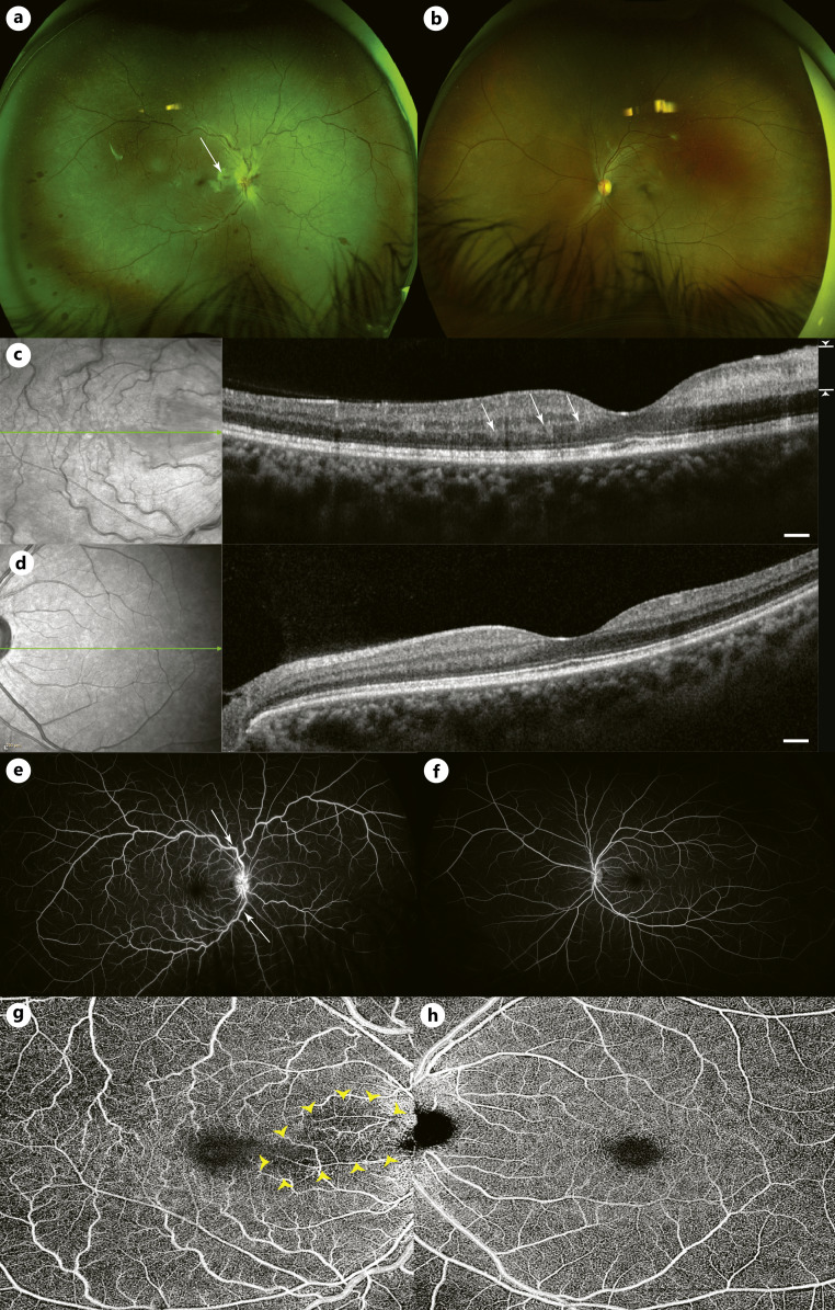 Ipsilateral, Multi-Phasic Retinal Vascular Events following Intralesional Triamcinolone Acetonide Injection for Earlobe Keloid: A Case Report.