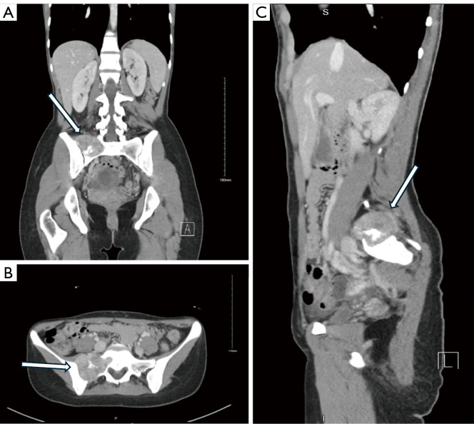 A 3D navigation-guided surgical resection of a rare case of sacral spine mesenchymal chondrosarcoma: a case report.