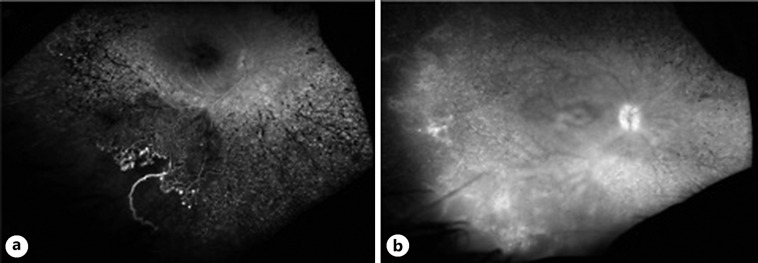 Bilateral Vasoproliferative Tumors in Usher Syndrome.