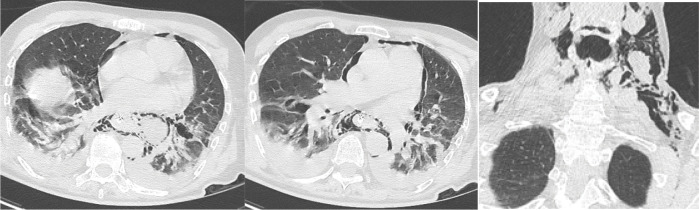 Boerhaave Syndrome: A Case Report.