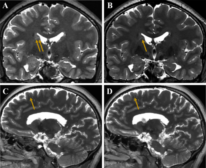 Visualization of perivascular spaces in the human brain with 5-T magnetic resonance imaging.